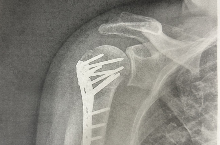 Shoulder Surgery